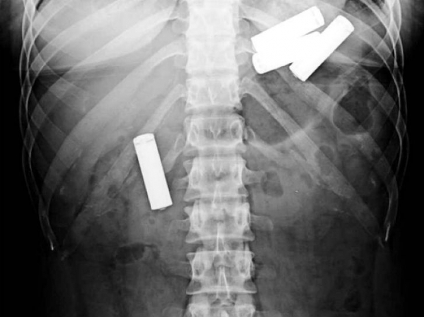 The worst items that have ever found in a human stomach