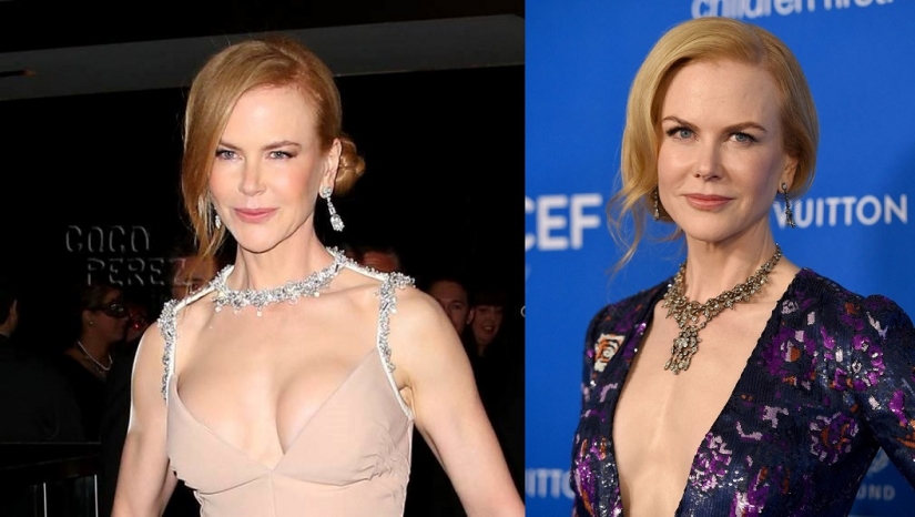 Véase más arriba: la estrella, que se sometieron a cirugía de reducción de senos