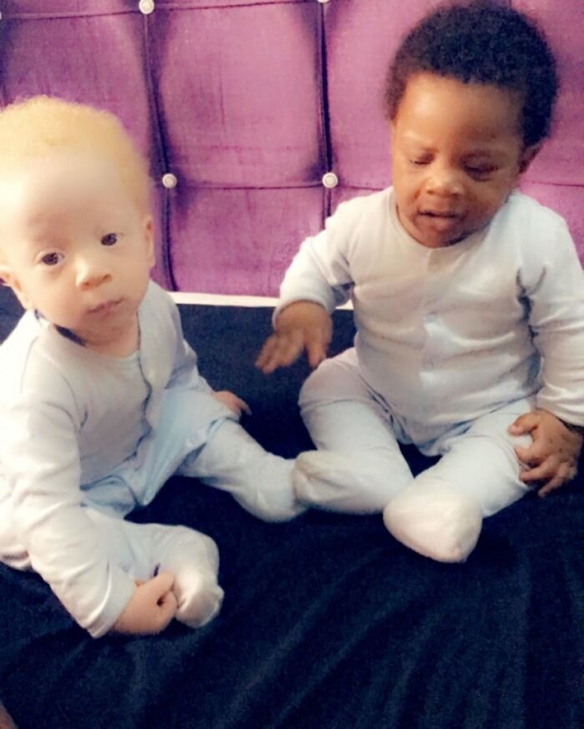 What is the secret of twins with different skin colors from Nigeria What is the secret of twins with different skin colors from Nigeria