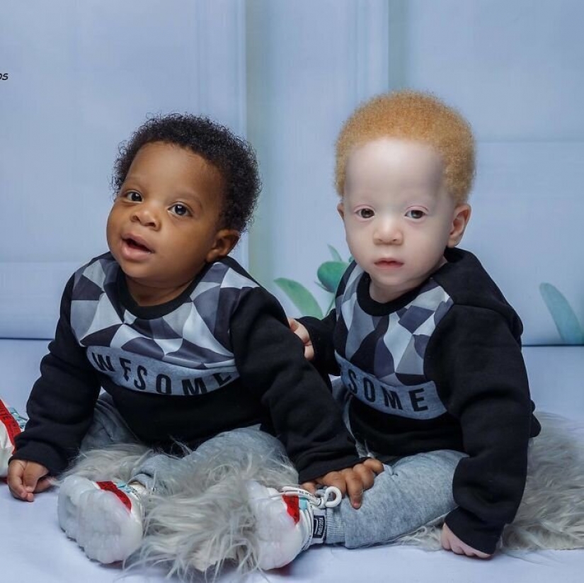 What is the secret of twins with different skin colors from Nigeria What is the secret of twins with different skin colors from Nigeria