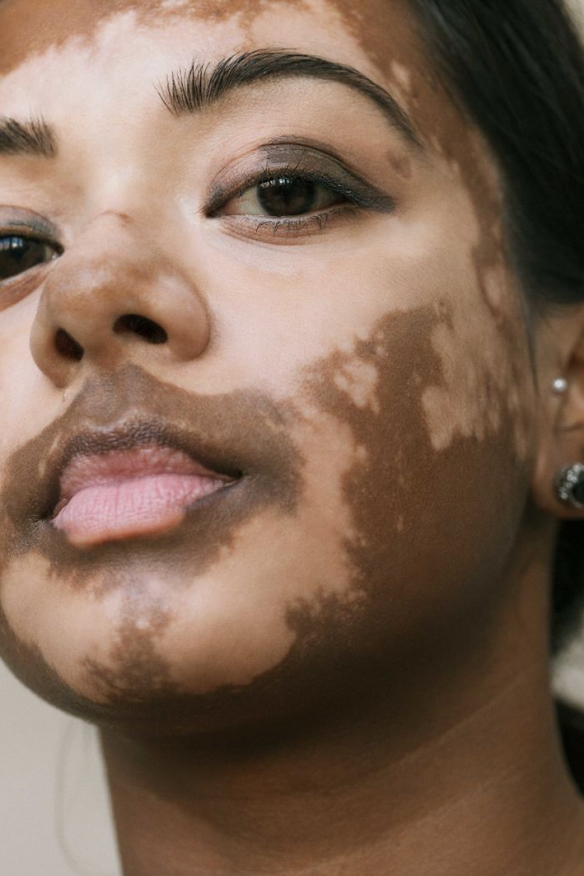 10 hermosas mujeres con vitiligo, fotografiadas por un fotógrafo con la misma condición 10 hermosas mujeres con vitiligo, fotografiadas por un fotógrafo con la misma condición