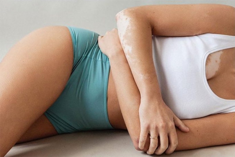 10 hermosas mujeres con vitiligo, fotografiadas por un fotógrafo con la misma condición 10 hermosas mujeres con vitiligo, fotografiadas por un fotógrafo con la misma condición