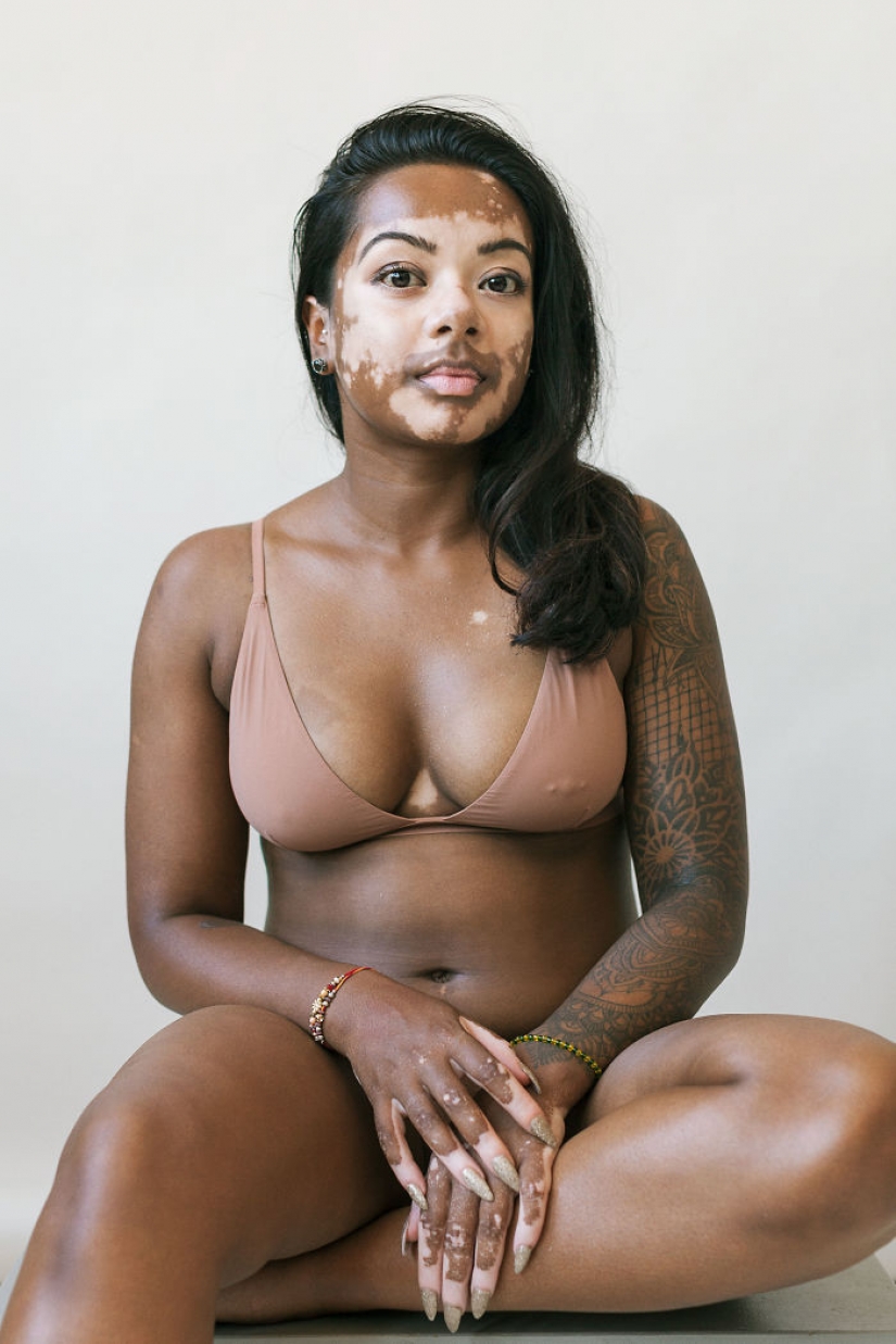 10 hermosas mujeres con vitiligo, fotografiadas por un fotógrafo con la misma condición 10 hermosas mujeres con vitiligo, fotografiadas por un fotógrafo con la misma condición