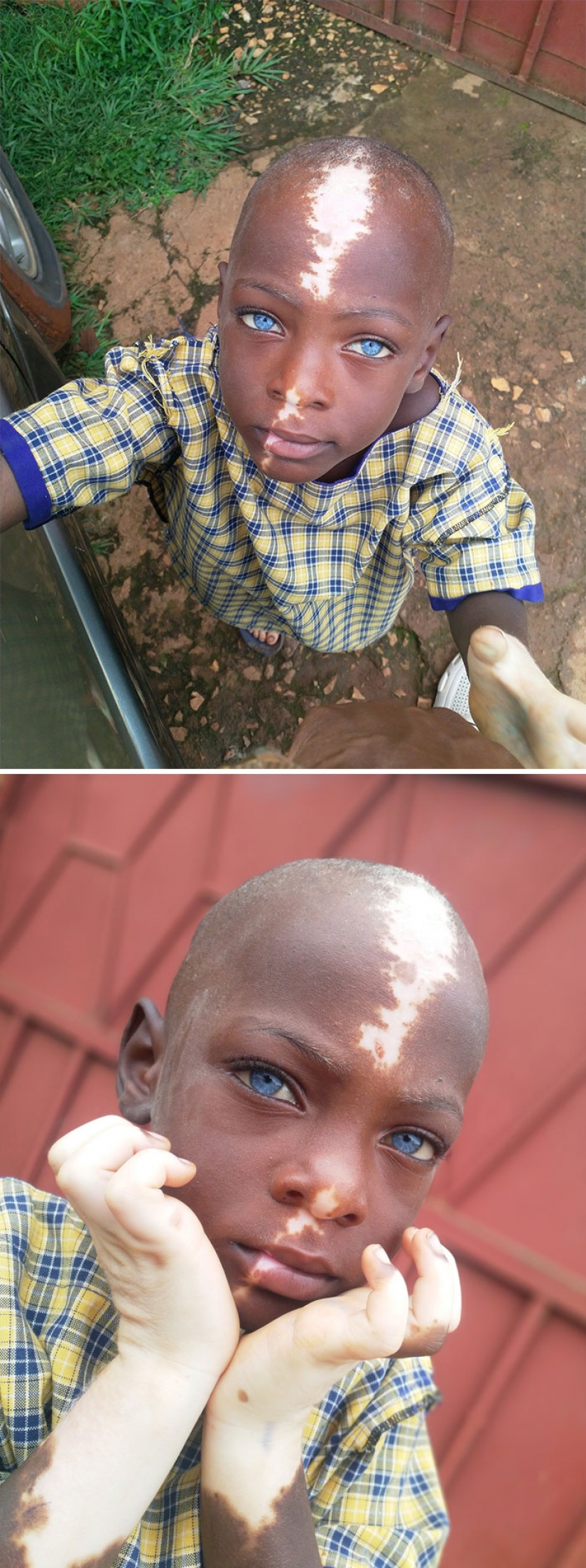 10 people whose genetics made them unique