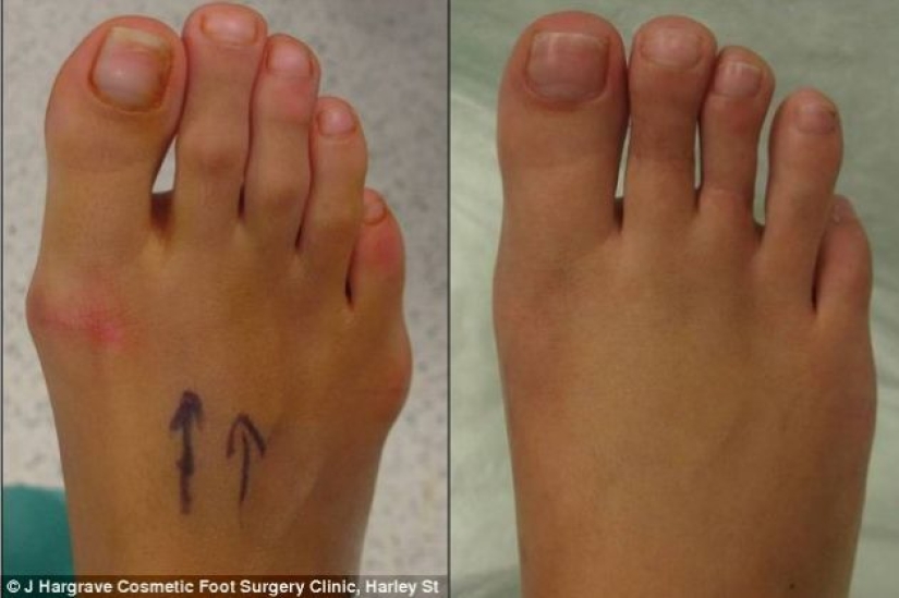 7 horrible cosmetic procedures popular in Hollywood 7 horrible cosmetic procedures popular in Hollywood