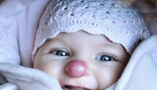 A young British woman who was born with a spot on her nose helps people with flaws in appearance