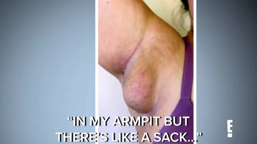 After giving birth, the American woman grew "breasts" under her arms, from which milk oozed