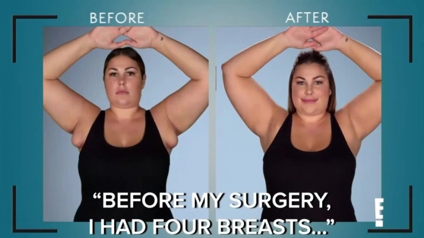 After giving birth, the American woman grew "breasts" under her arms, from which milk oozed