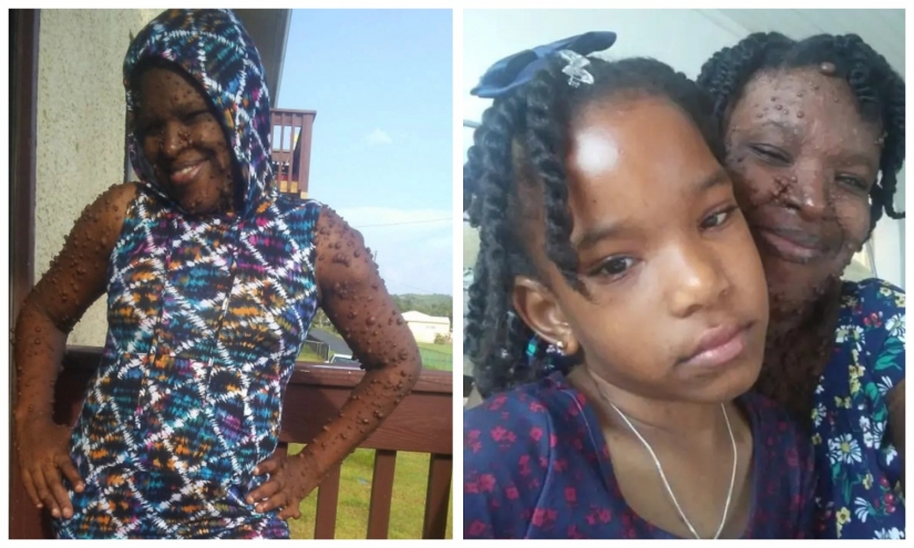 An American woman whose body is covered with two hundred tumors has gained self-confidence thanks to her daughter An American woman whose body is covered with two hundred tumors has gained self-confidence thanks to her daughter