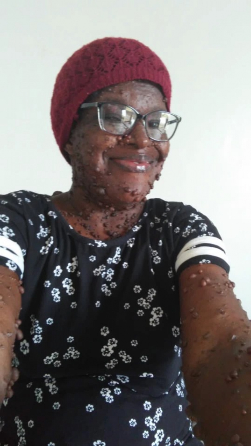 An American woman whose body is covered with two hundred tumors has gained self-confidence thanks to her daughter An American woman whose body is covered with two hundred tumors has gained self-confidence thanks to her daughter