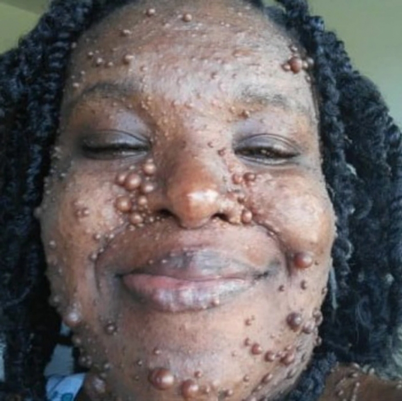 An American woman whose body is covered with two hundred tumors has gained self-confidence thanks to her daughter An American woman whose body is covered with two hundred tumors has gained self-confidence thanks to her daughter