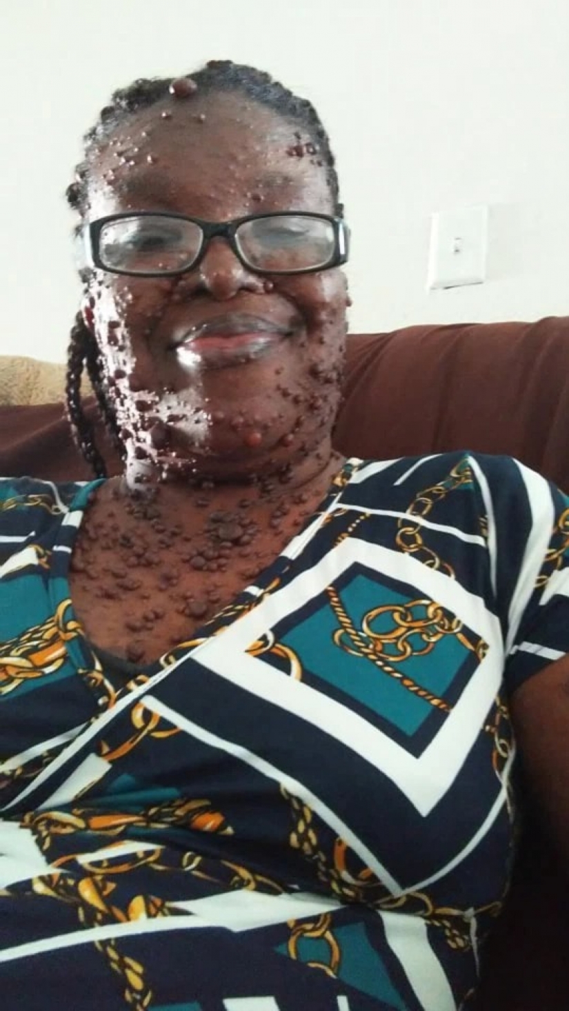 An American woman whose body is covered with two hundred tumors has gained self-confidence thanks to her daughter An American woman whose body is covered with two hundred tumors has gained self-confidence thanks to her daughter