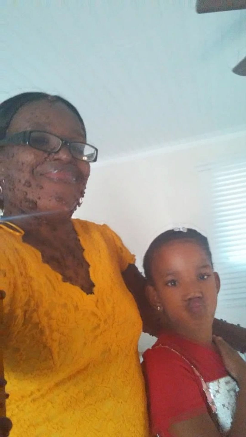 An American woman whose body is covered with two hundred tumors has gained self-confidence thanks to her daughter An American woman whose body is covered with two hundred tumors has gained self-confidence thanks to her daughter