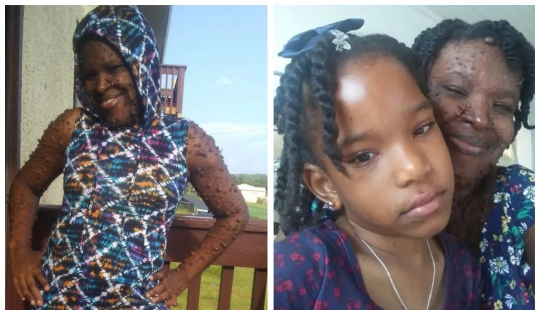 An American woman whose body is covered with two hundred tumors has gained self-confidence thanks to her daughter