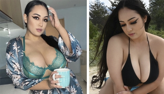 An Australian woman with continuously growing breasts told about her difficult life