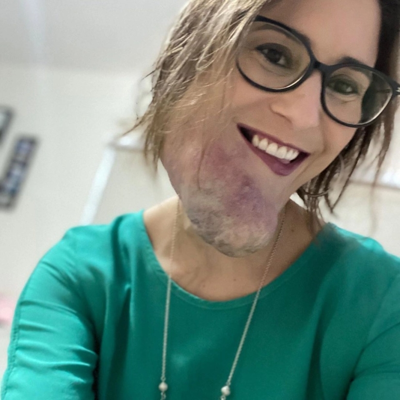 Beauty, no matter what: a Brazilian woman with a rare disease admires self-confidence