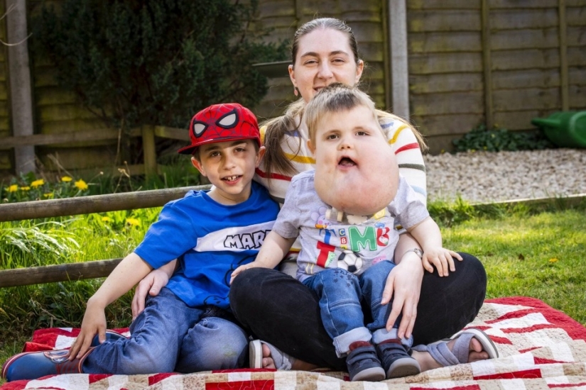 Con fe en lo mejor: un niño de 4 años con un tumor en la cara no pierde el corazón, a pesar de la enfermedad Con fe en lo mejor: un niño de 4 años con un tumor en la cara no pierde el corazón, a pesar de la enfermedad