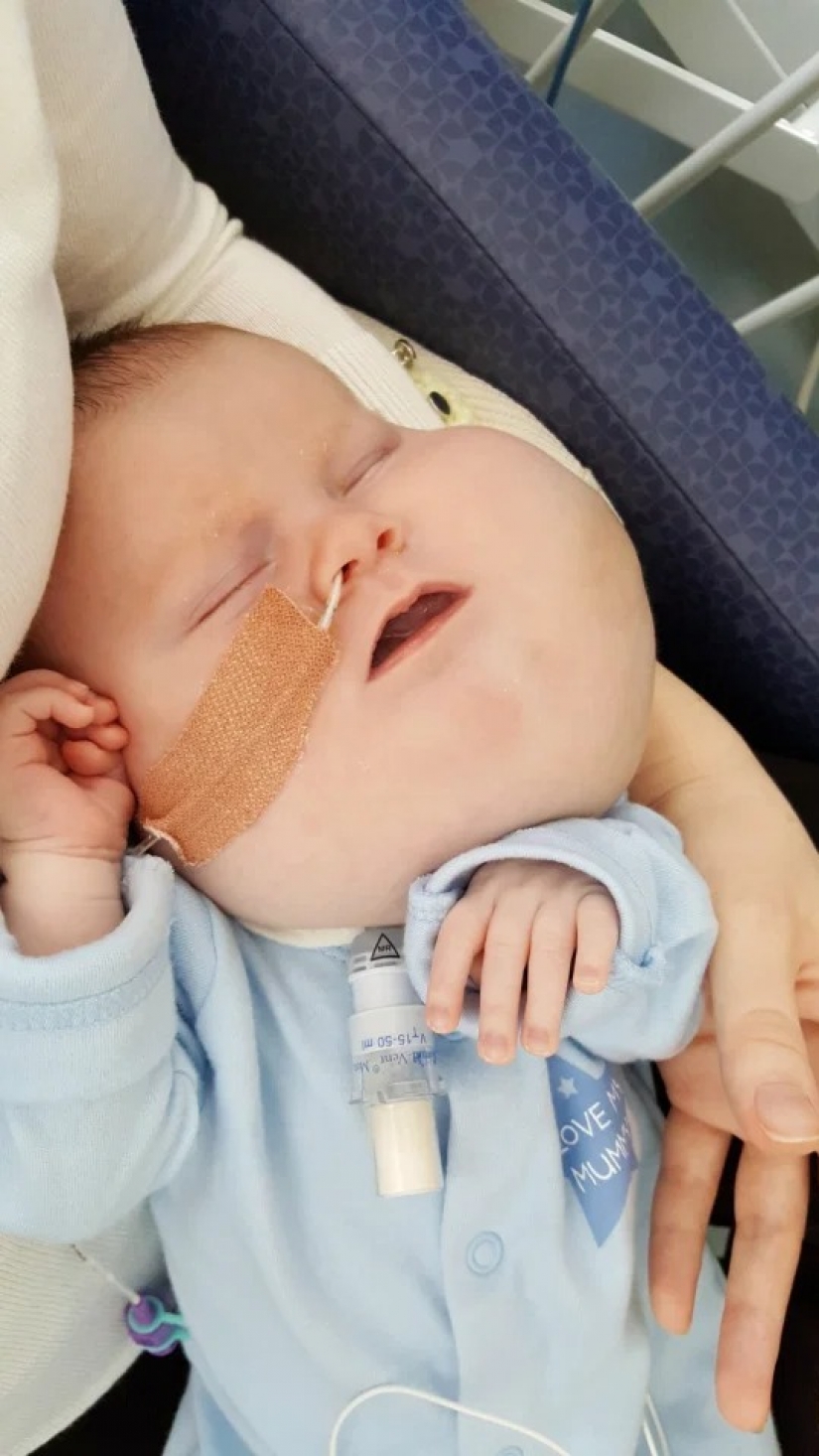 Con fe en lo mejor: un niño de 4 años con un tumor en la cara no pierde el corazón, a pesar de la enfermedad Con fe en lo mejor: un niño de 4 años con un tumor en la cara no pierde el corazón, a pesar de la enfermedad