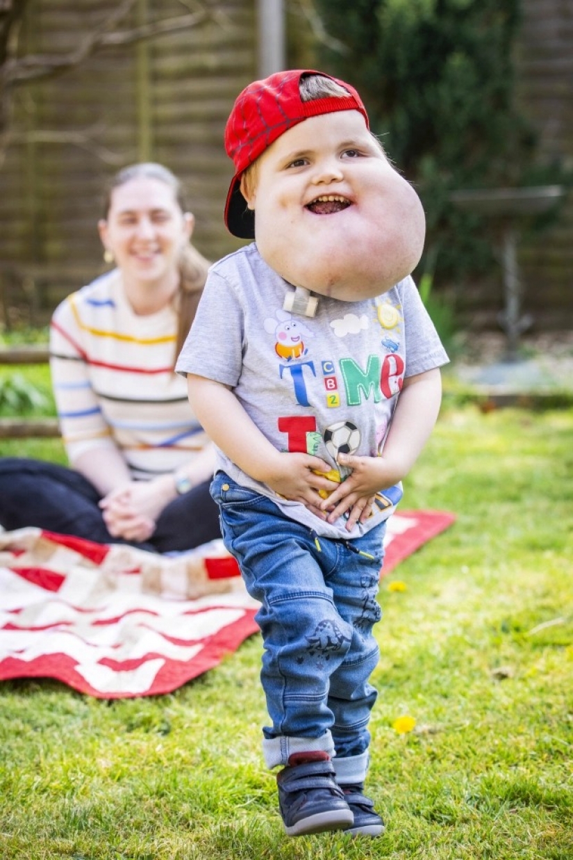 Con fe en lo mejor: un niño de 4 años con un tumor en la cara no pierde el corazón, a pesar de la enfermedad Con fe en lo mejor: un niño de 4 años con un tumor en la cara no pierde el corazón, a pesar de la enfermedad