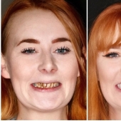 Con una sonrisa para toda la vida: cómo una chica se transformó con dientes terribles