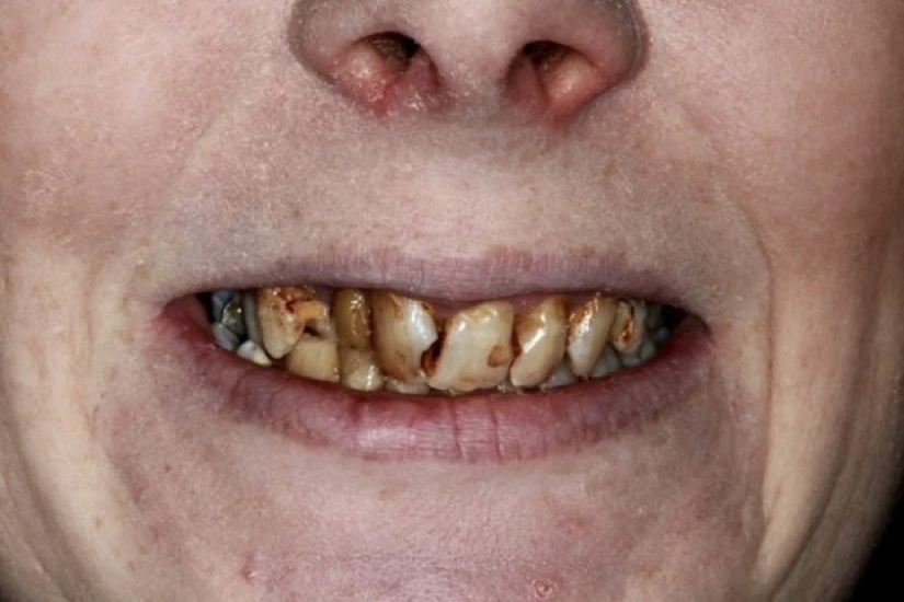 Con una sonrisa para toda la vida: cómo una chica se transformó con dientes terribles Con una sonrisa para toda la vida: cómo una chica se transformó con dientes terribles