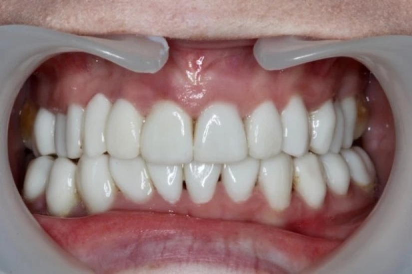 Con una sonrisa para toda la vida: cómo una chica se transformó con dientes terribles Con una sonrisa para toda la vida: cómo una chica se transformó con dientes terribles