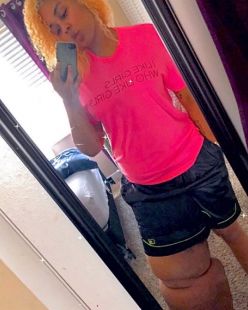 "Cut off your leg!": how an American woman with a 45-kilogram limb learned to love herself