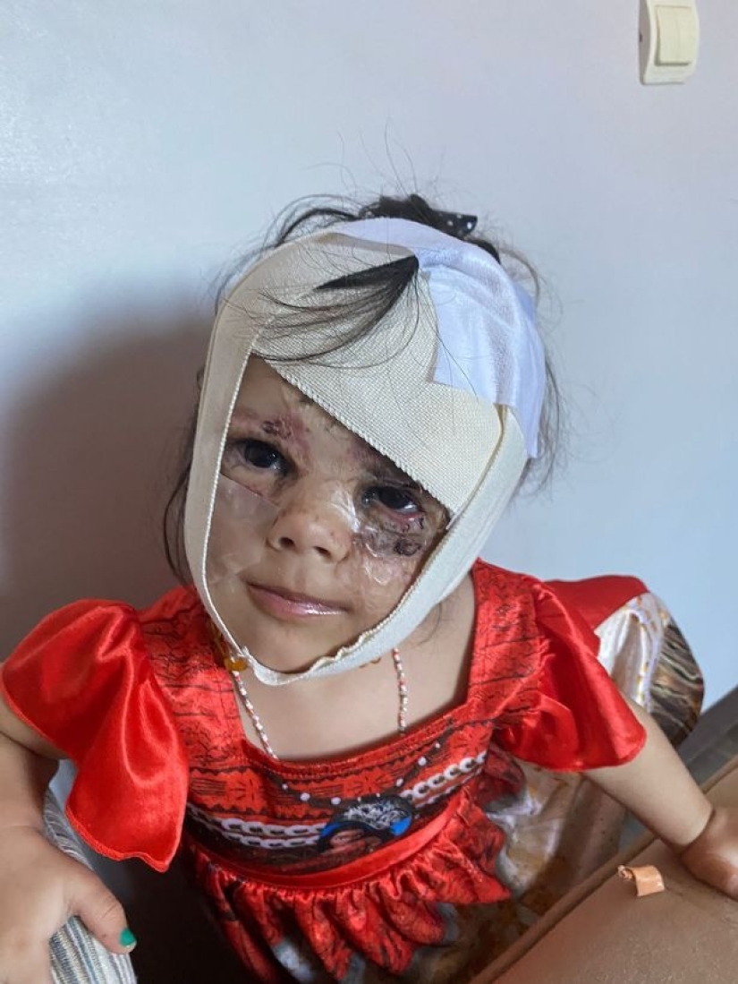 De Batman a Princesa: los médicos rusos eliminaron una enorme marca de nacimiento de la cara de una mujer estadounidense de 2 años