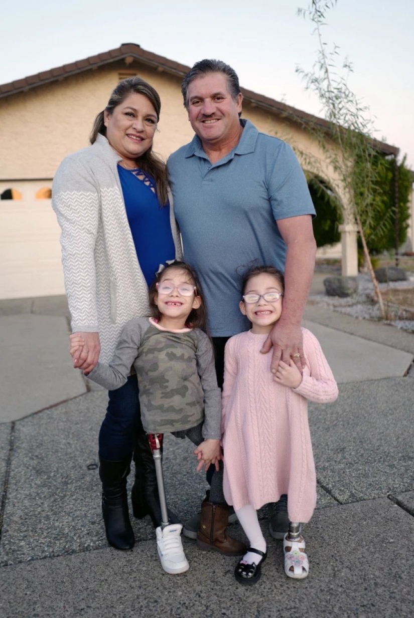 Difícil elección: los padres de los Estados Unidos tienen miedo de tomar una decisión sobre la separación de los gemelos siameses