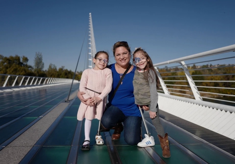 Difícil elección: los padres de los Estados Unidos tienen miedo de tomar una decisión sobre la separación de los gemelos siameses