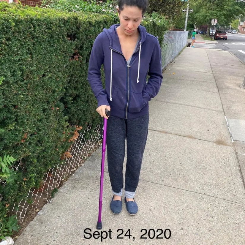 Efecto secundario: una mujer estadounidense ha soportado un sufrimiento terrible debido a los esteroides para tratar el eccema