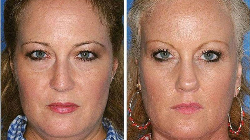 Efectos del tabaquismo en el ejemplo de los gemelos