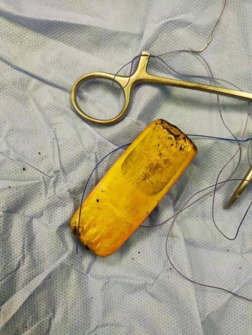 Egyptian doctors took out a mobile phone from the patient's intestines, which had been there for six months Egyptian doctors took out a mobile phone from the patient's intestines, which had been there for six months