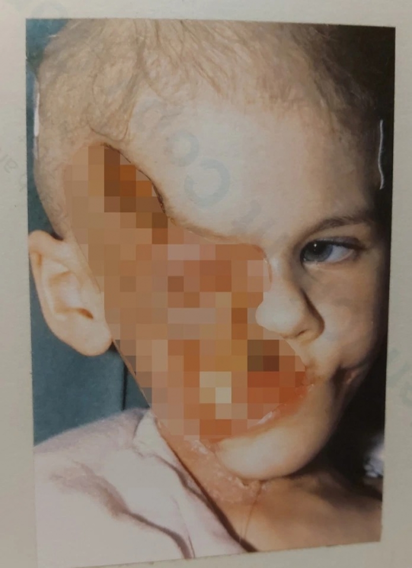 El amor mira al corazón: cómo una mujer irlandesa con el rostro desfigurado encontró su felicidad femenina