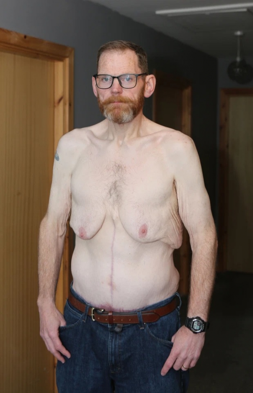 El británico más gordo perdió 270 kg porque tenía miedo de aplastar a su esposa en la cama El británico más gordo perdió 270 kg porque tenía miedo de aplastar a su esposa en la cama