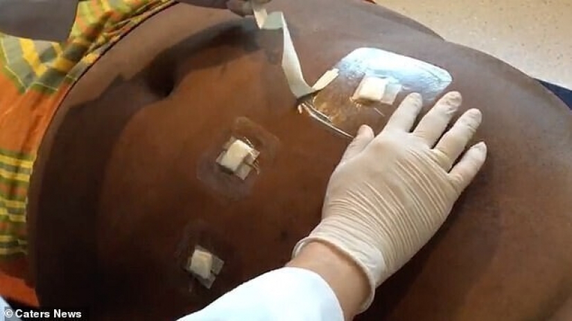 El más gordo de chico en el mundo perdió más allá del reconocimiento: así se ve ahora