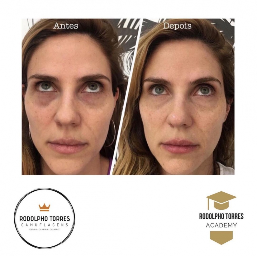 En lugar de cirujanos y cremas: un tatuador brasileño se deshace de las estrías de una manera poco convencional En lugar de cirujanos y cremas: un tatuador brasileño se deshace de las estrías de una manera poco convencional