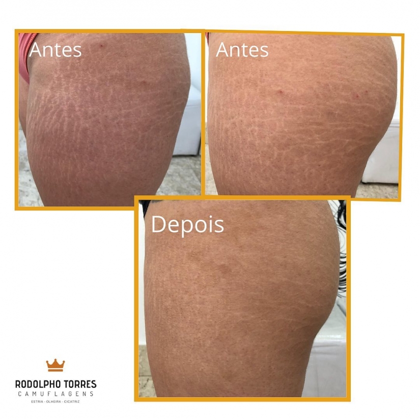 En lugar de cirujanos y cremas: un tatuador brasileño se deshace de las estrías de una manera poco convencional En lugar de cirujanos y cremas: un tatuador brasileño se deshace de las estrías de una manera poco convencional