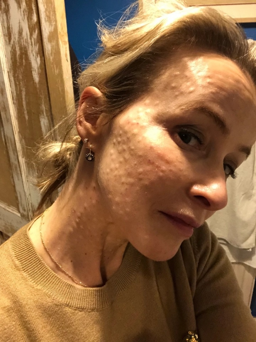 En su propia piel: la mujer británica experimentó los efectos de los procedimientos cosméticos de moda