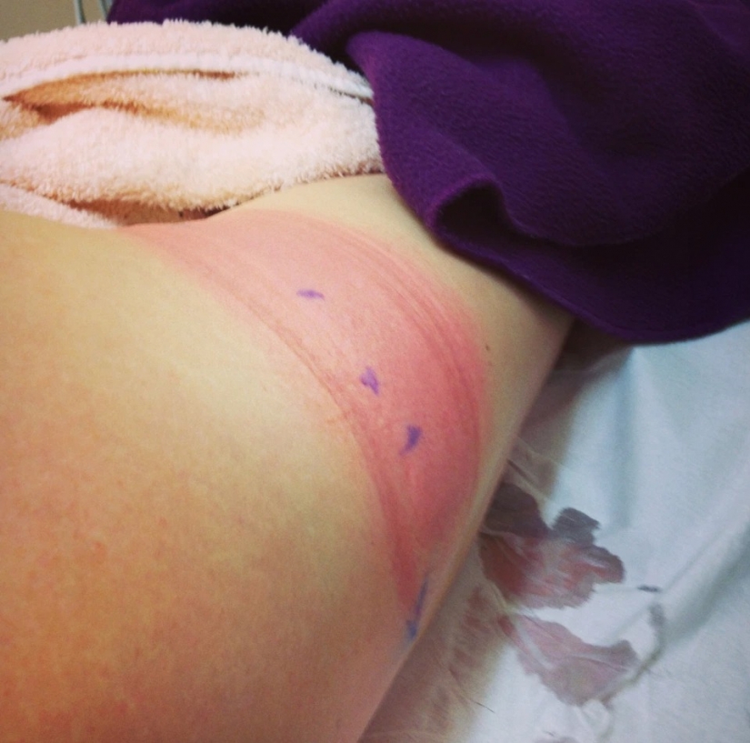 En su propia piel: la mujer británica experimentó los efectos de los procedimientos cosméticos de moda