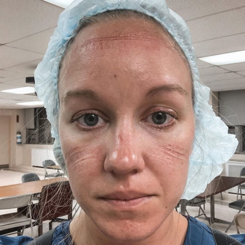 "Estas heridas no desaparecerán, permanecerán dentro de nosotros": fotos de chicas médicas con rastros de máscaras en sus rostros "Estas heridas no desaparecerán, permanecerán dentro de nosotros": fotos de chicas médicas con rastros de máscaras en sus rostros