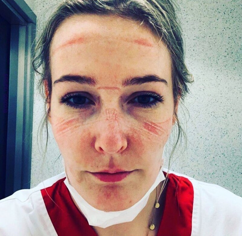"Estas heridas no desaparecerán, permanecerán dentro de nosotros": fotos de chicas médicas con rastros de máscaras en sus rostros "Estas heridas no desaparecerán, permanecerán dentro de nosotros": fotos de chicas médicas con rastros de máscaras en sus rostros