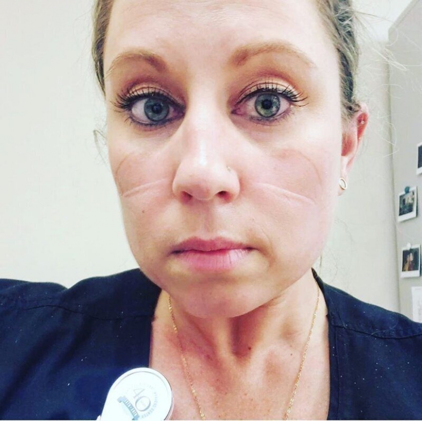 "Estas heridas no desaparecerán, permanecerán dentro de nosotros": fotos de chicas médicas con rastros de máscaras en sus rostros "Estas heridas no desaparecerán, permanecerán dentro de nosotros": fotos de chicas médicas con rastros de máscaras en sus rostros