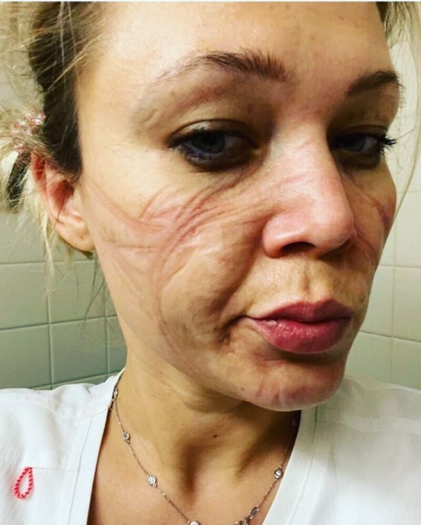 "Estas heridas no desaparecerán, permanecerán dentro de nosotros": fotos de chicas médicas con rastros de máscaras en sus rostros "Estas heridas no desaparecerán, permanecerán dentro de nosotros": fotos de chicas médicas con rastros de máscaras en sus rostros