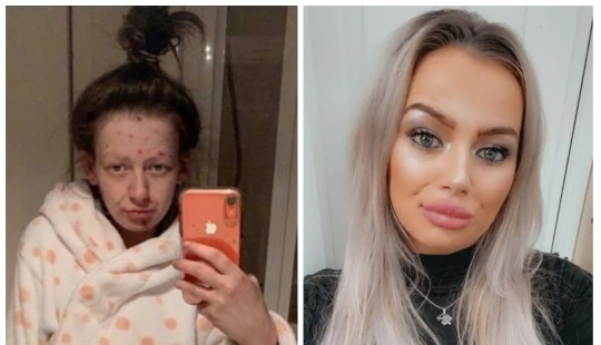 From a frog to a princess: a former drug addict became a beauty, getting rid of addiction From a frog to a princess: a former drug addict became a beauty, getting rid of addiction