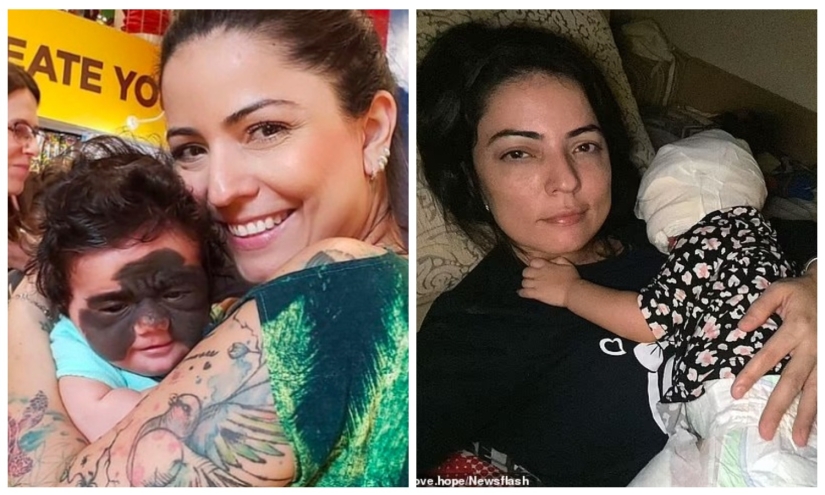 From Batman to Princess: Russian doctors removed a huge birthmark from the face of a 2-year-old American woman