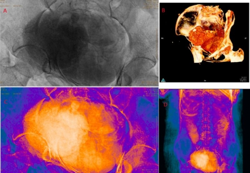 Hallazgo único: momia Egipcia resultó estar embarazada