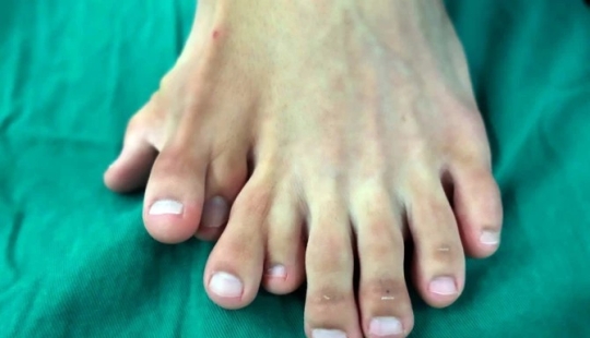 Happiness is never too much: the Chinese have long lived with 14 toes, considering the anomaly of happy sign