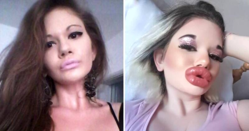 La mujer con los labios más grandes del mundo va a agrandar sus mejillas