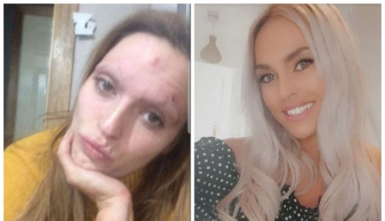 La mujer escocesa se ha convertido de un drogadicto hosco en una verdadera belleza, habiendo superado las adicciones La mujer escocesa se ha convertido de un drogadicto hosco en una verdadera belleza, habiendo superado las adicciones